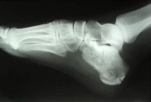 Best Shoe After Calcaneal Fracture