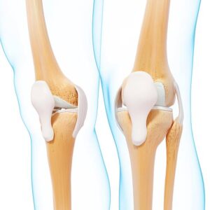 Exploring Joint Replacement