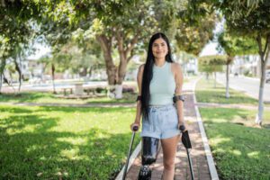 Long-Term Outcomes and Quality of Life After Amputation