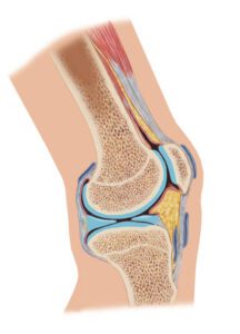 Understanding Osteotomy