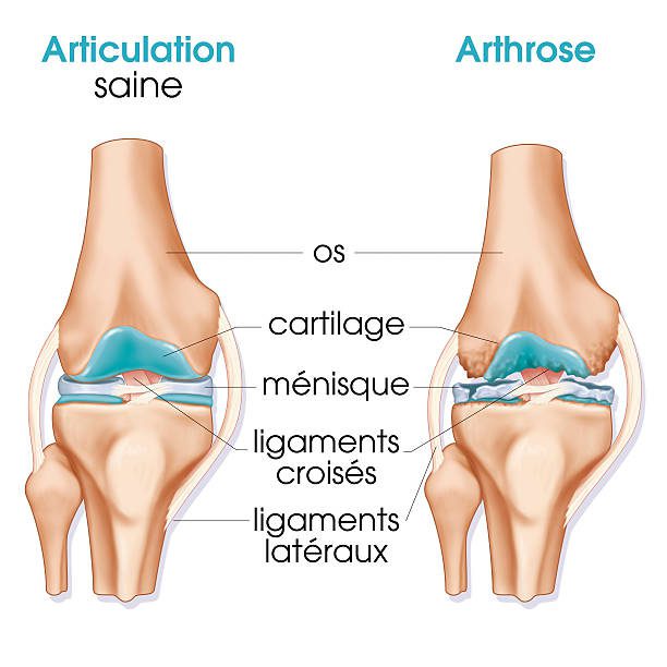 Meniscus Repair vs. Meniscectomy: Which is Right for You?