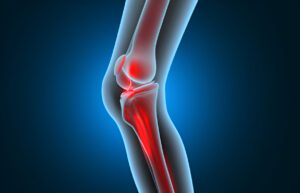 Cross-section of knee joint showing inflamed meniscus and surrounding structures