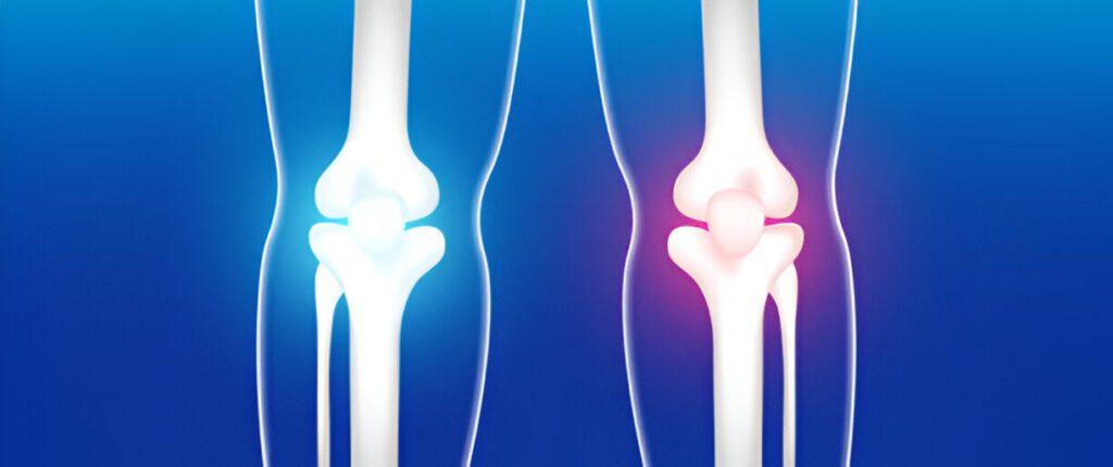 Medical illustration comparing two knee joints with highlighted areas of cartilage damage