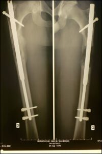 Post-surgical radiograph demonstrating intramedullary nail fixation used in modern limb lengthening procedures, showing precise alignment and stabilization of the extended bone segments.