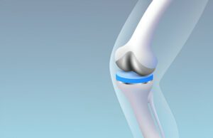 3D medical illustration of knee joint prosthesis with metallic and polymer components.