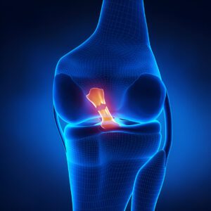 3D medical illustration showing a blue translucent knee joint with highlighted orange meniscus in anatomical cross-section