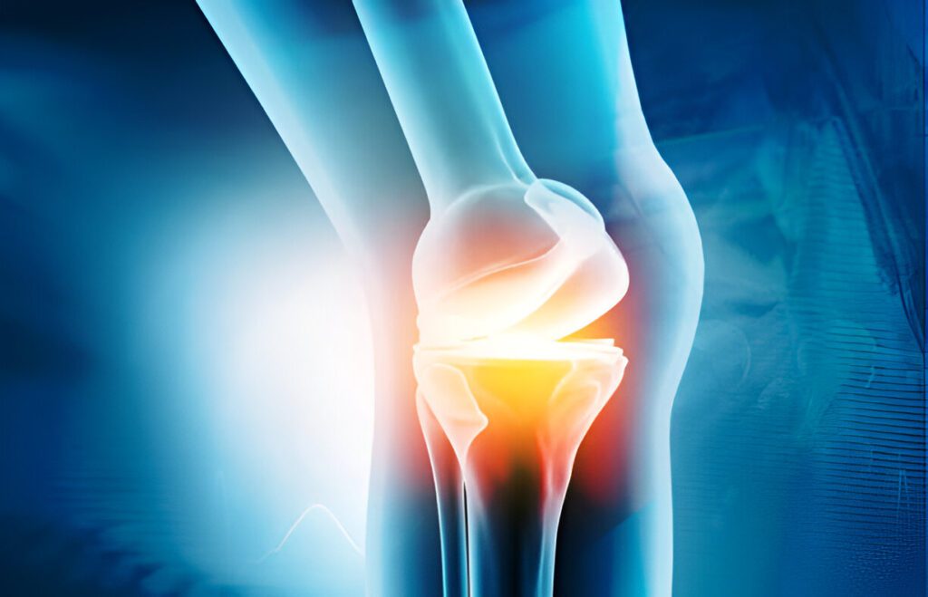 Cross-sectional view of knee prosthesis placement with anatomical overlay in blue tones