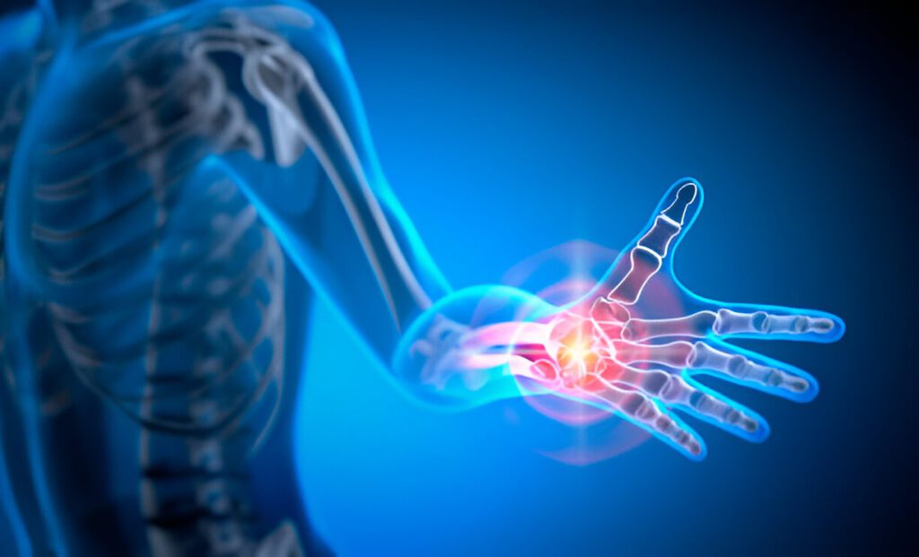 3D medical visualization of hand and wrist bones with highlighted joint inflammation in blue and red coloring