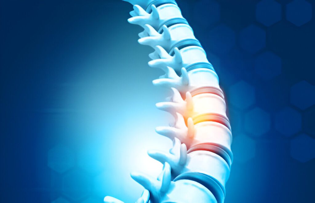 Close-up 3D rendering of spinal vertebrae with highlighted surgical site showing post-operative inflammation