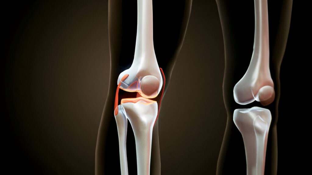 Dual view of knee joint anatomy showing detailed bone structure and ligament placement