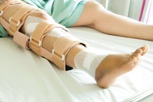 Beige medical leg brace with multiple straps and padding on patient's leg in hospital setting