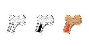  Medical illustration showing three cross-sectional views of bone tissue demonstrating different stages of bone density, from normal to deteriorated structure